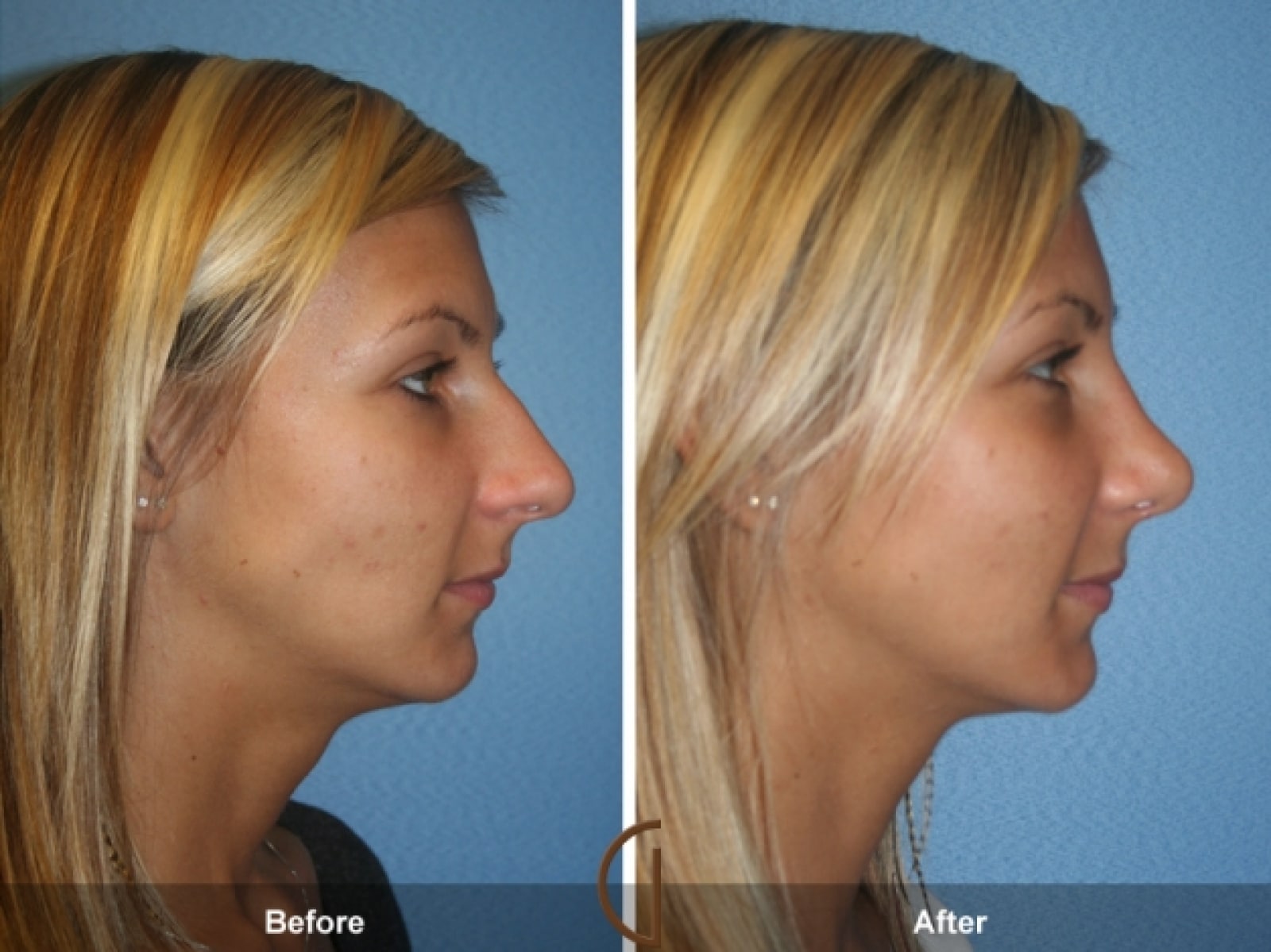 Enjoy this service by finding a Non surgical nose job near me. post thumbnail image
