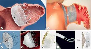 Watchman Device: Advancing Cardiac Care for AFib Patients post thumbnail image